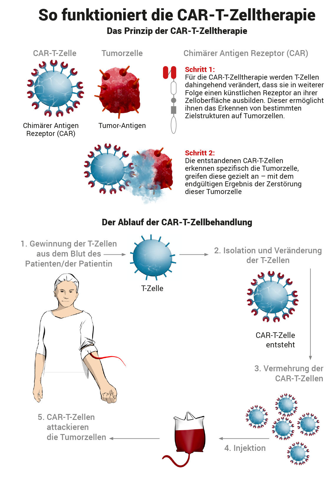 CAR-T-Zelltherapie Auf Einen Blick | CAR-T-Zell Therapie